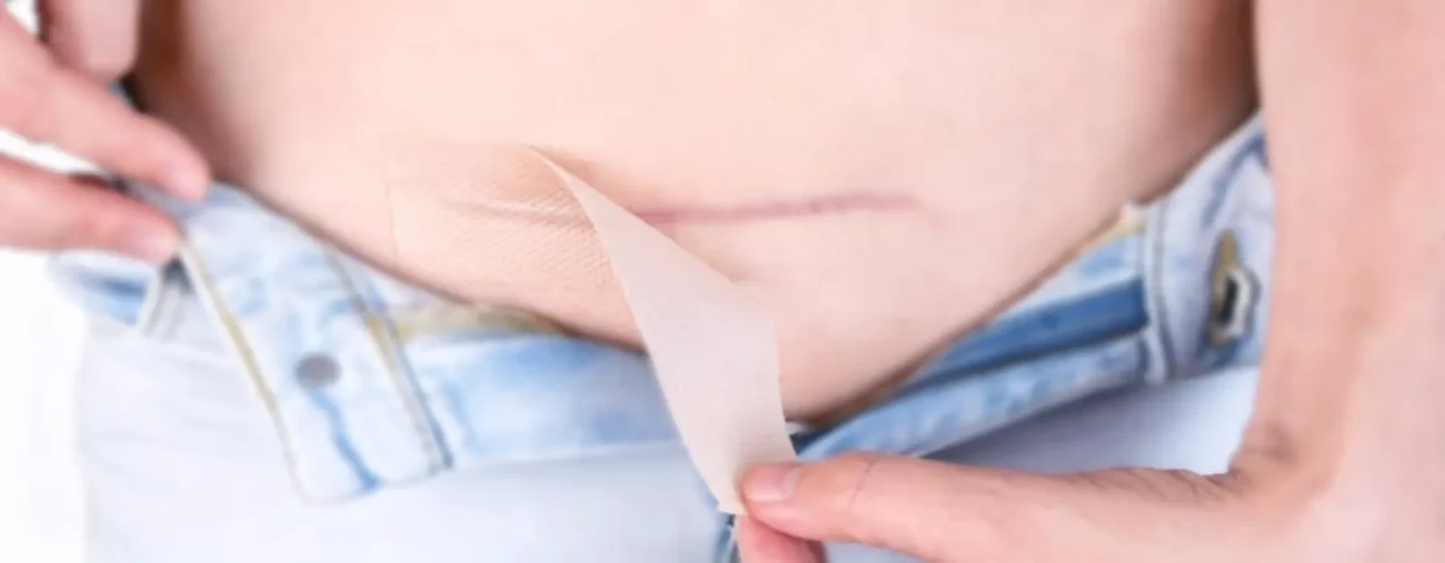 The Best Surgical Dressings for Different Types of Surgical Wounds